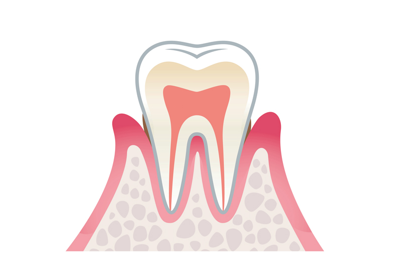 歯周炎（軽度）