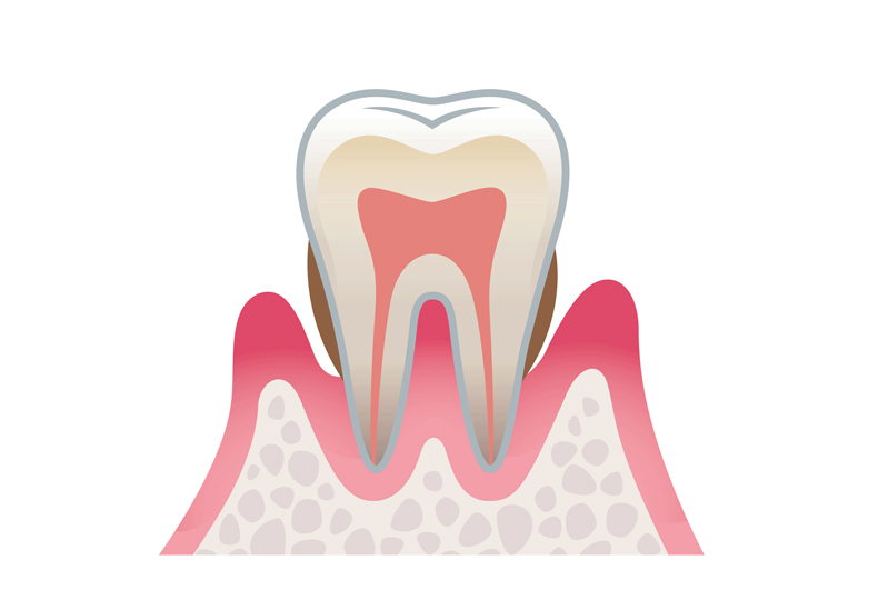 歯周炎（中度）