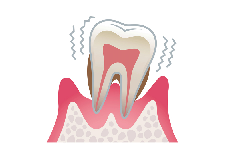 歯周炎（重度）