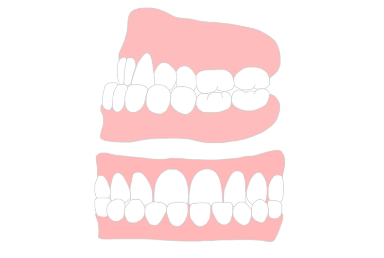 反対咬合（下顎前突）